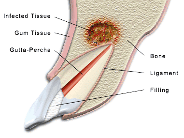 Apicoectomy to treat infection at the tooth's root tip