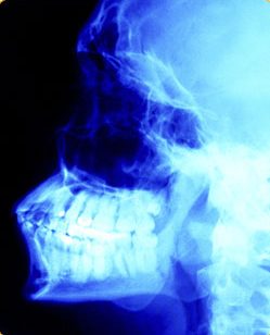 X-ray of mouth left side, jaw side-view X-ray